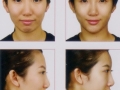 filler face shaping- nose, chin, cheek enhancement 1