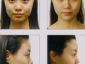 filler face shaping- nose, chin, cheek enhancement 2