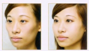filler face shaping- cheek augmentation