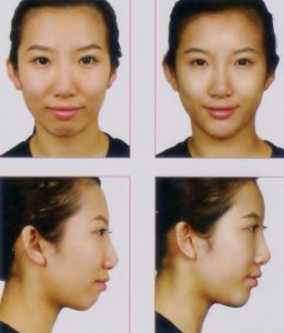 Nose and Chin Augmentation