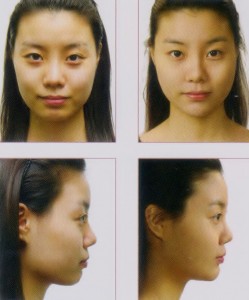 Nose and Chin Augmentation