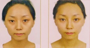 Cheek Augmentation (Apple of the face)