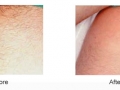 permanent-hair-removal-2