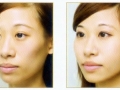 filler-face-shaping--cheek-augmentation