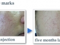 PRP-acne-scar