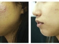 acne-scar-removal