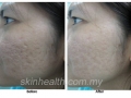 acne-scar-removal2