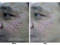 acne-scar-removal3